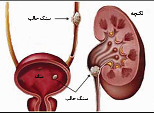 سنگ مجاري ادراري